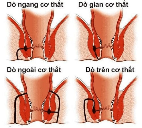 Định nghĩa rò hậu môn cơ thắt là gì?