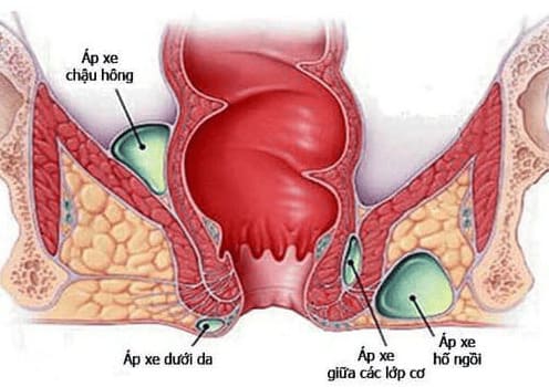 Nguyên nhân gây rò hậu môn cơ thắt là gì?