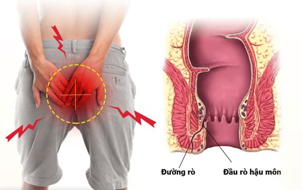 Nguyên nhân gây ra bệnh lý rò hậu môn