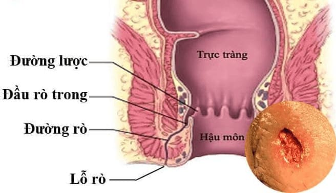 Tìm hiểu rò hậu môn ở trẻ em là gì?