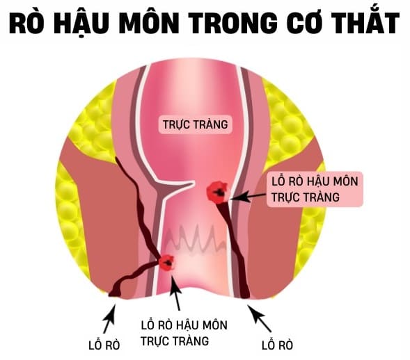 Rò hậu môn trong cơ thắt 