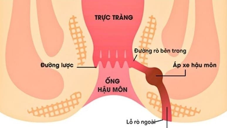 Tổng quan bệnh rò hậu môn