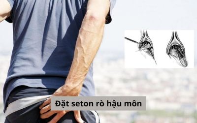 [Tư vấn] Có nên đặt seton rò hậu môn không? Hiệu quả ra sao?
