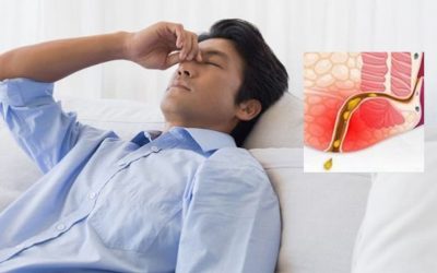 Chữa rò hậu môn không cần phẫu thuật liệu có thực sự hiệu quả?