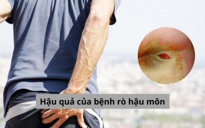 Hậu quả của bệnh rò hậu môn và cách điều trị dứt điểm