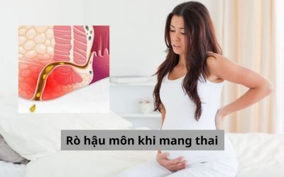 Nỗi ám ảnh của mẹ bầu – Mắc chứng rò hậu môn khi mang thai