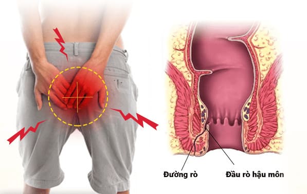 Mức độ nguy hiểm của rò hậu môn