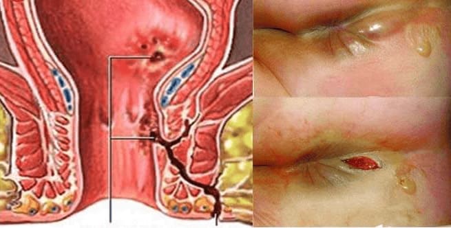 Thời điểm cần khám rò hậu môn ngay