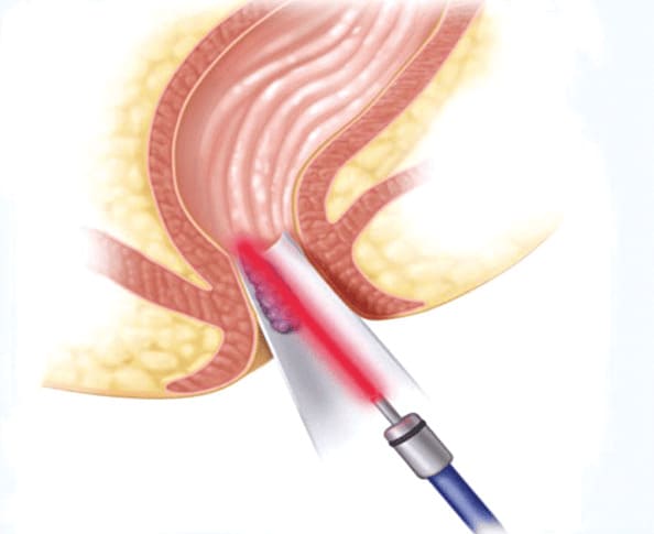 Mổ laser rò hậu môn là gì?