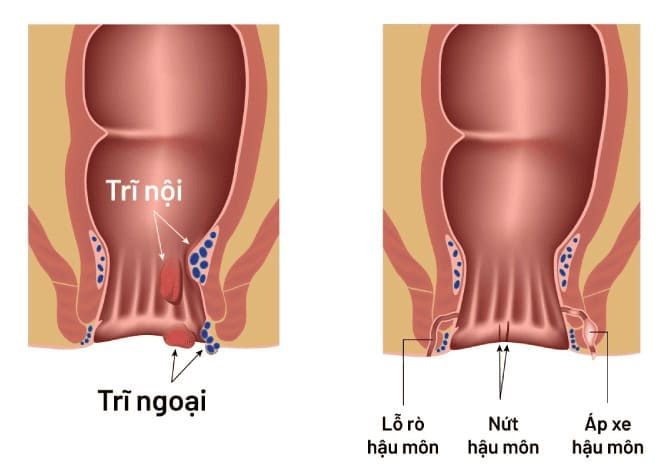 Rò hậu môn sau mổ trĩ vì sao thường xuất hiện?