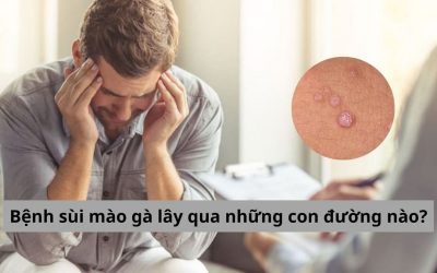 Thắc mắc: Bệnh sùi mào gà lây qua những con đường nào?