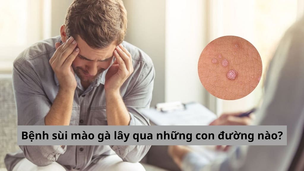 Thắc mắc: Bệnh sùi mào gà lây qua những con đường nào?