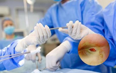 Mổ rò hậu môn ở đâu tốt nhất: Hiệu quả và An toàn