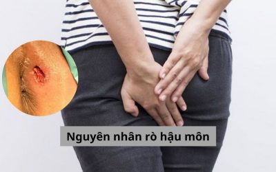 Tổng hợp 6 nguyên nhân rò hậu môn và cách phòng ngừa hiệu quả