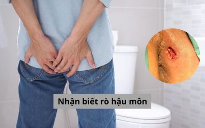 Nhận biết rò hậu môn sớm qua các triệu chứng điển hình!
