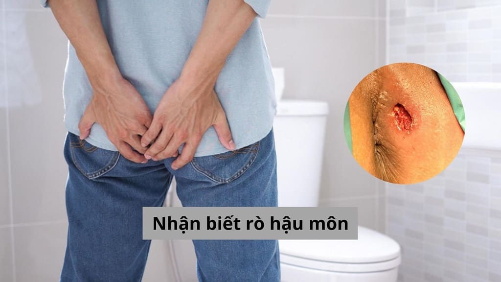Nhận biết rò hậu môn sớm qua các triệu chứng điển hình!