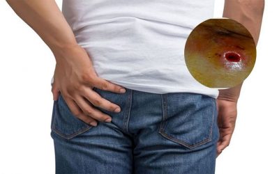 Tổn thương của rò hậu môn như nào? Có nguy hiểm không?