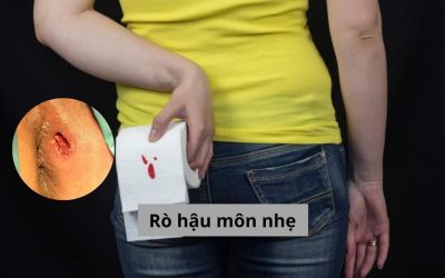 Rò hậu môn nhẹ và những thông tin quan trọng bạn cần biết