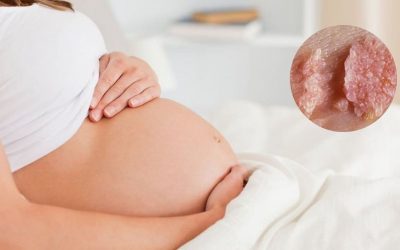 Thai phụ mắc sùi mào gà có ảnh hưởng đến thai nhi không?