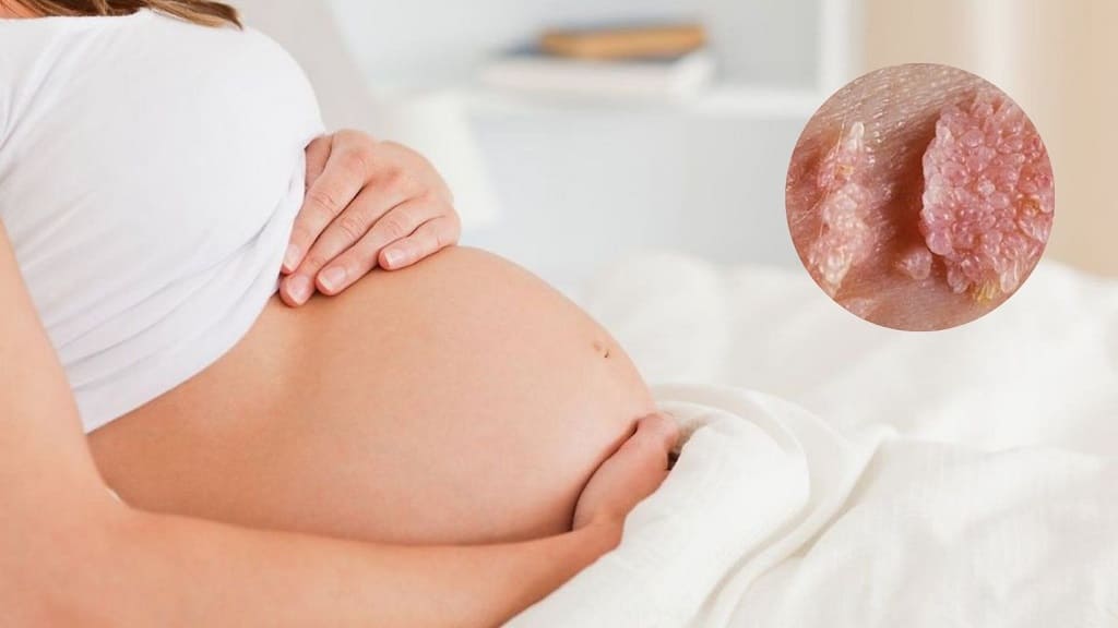 Thai phụ mắc sùi mào gà có ảnh hưởng đến thai nhi không?