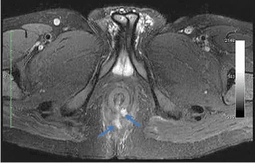 Chụp MRI rò hậu môn là gì?