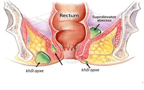 Nguyên nhân gây rò hậu môn - Biến chứng apxe hậu môn