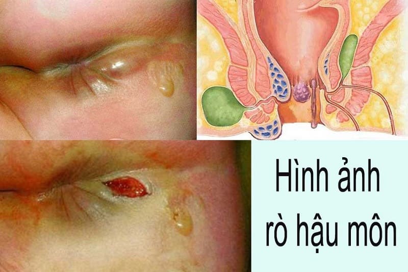 Những triệu chứng của rò hậu môn