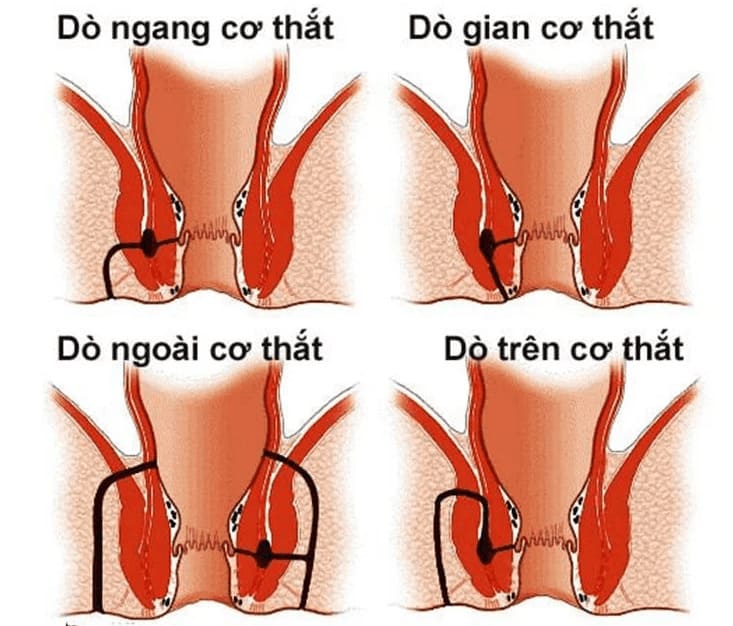 Rò hậu môn ngoài cơ thắt 