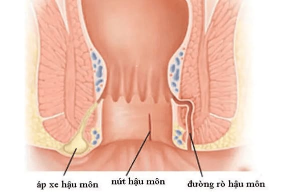 Nguyên nhân dẫn tới tình trạng rò hậu môn nhẹ