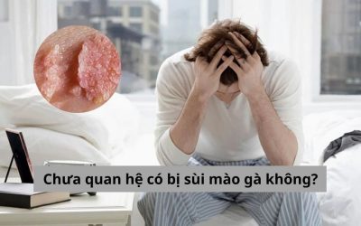 Giải đáp thắc mắc từ chuyên gia: Chưa quan hệ có bị sùi mào gà không?