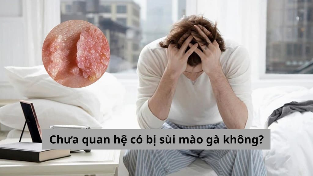 Giải đáp thắc mắc từ chuyên gia: Chưa quan hệ có bị sùi mào gà không?