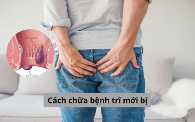 Tìm hiểu cách chữa bệnh trĩ mới bị tại nhà hiệu quả nhanh – an toàn