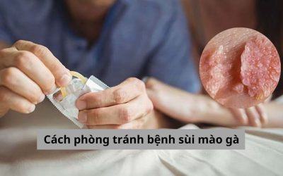 Đâu là cách phòng tránh bệnh sùi mào gà hiệu quả?