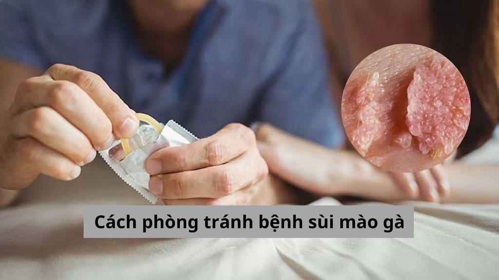 Đâu là cách phòng tránh bệnh sùi mào gà hiệu quả?