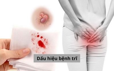 Đừng chủ quan với dấu hiệu bệnh trĩ trước khi quá muộn