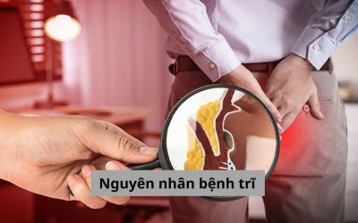 Giải đáp thắc mắc: Nguyên nhân bệnh trĩ đến từ đâu?