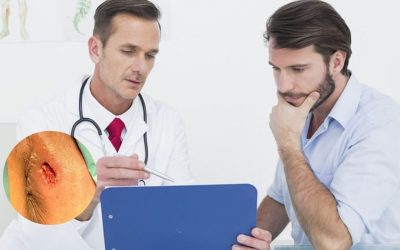 [Chuyên gia giải đáp] Tình hiểu từ A – Z về rò hậu môn ở nam giới 
