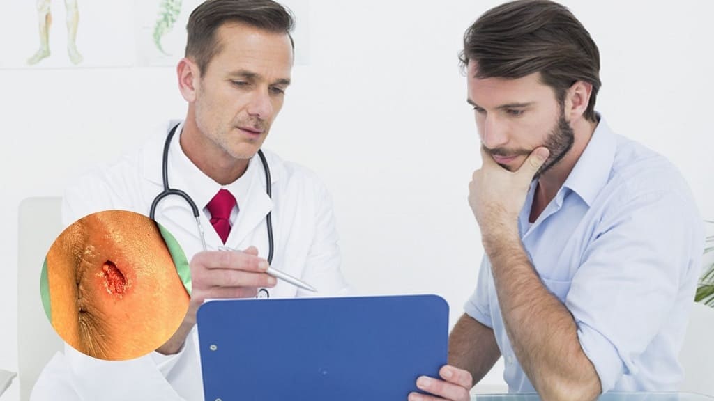 [Chuyên gia giải đáp] Tình hiểu từ A – Z về rò hậu môn ở nam giới 