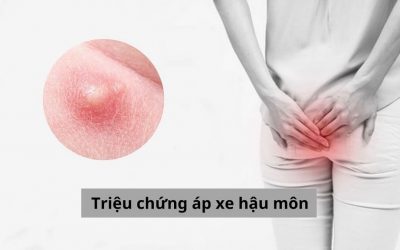 Cảnh báo những triệu chứng áp xe hậu môn không được bỏ qua