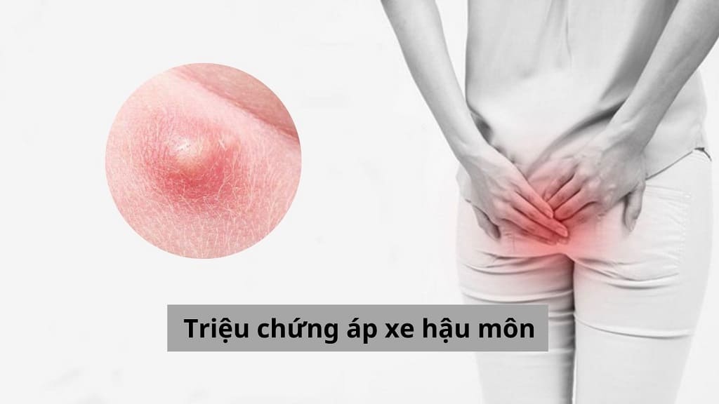 Cảnh báo những triệu chứng áp xe hậu môn không được bỏ qua
