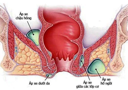 Yếu tố gây ra áp xe hậu môn