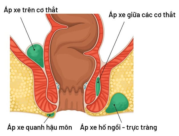 Apxe hậu môn