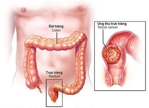 Bệnh trĩ có dẫn đến ung thư không?