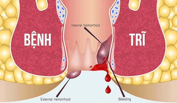 Bạn đã thực sự hiểu rõ về căn bệnh trĩ hay chưa?