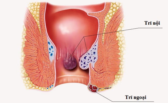 Bệnh trĩ là gì?