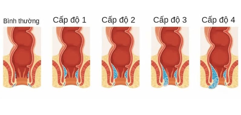 Các cấp độ dấu hiệu bệnh trĩ