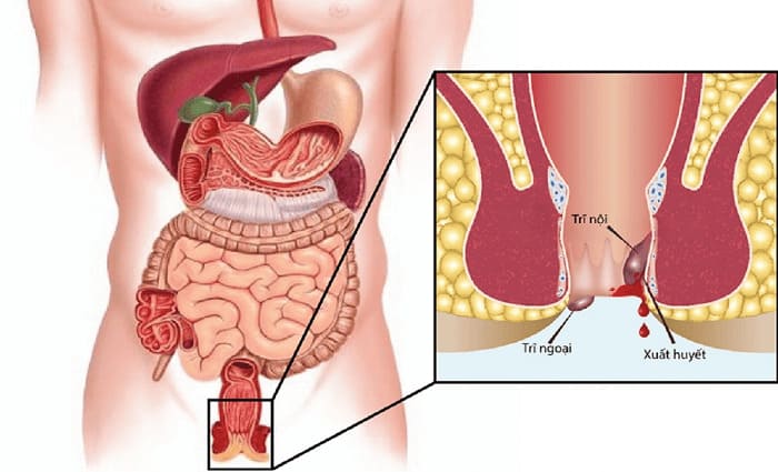 Dấu hiệu bệnh trĩ nặng dẫn đến những biến chứng nguy hiểm