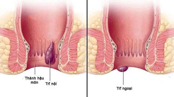 Tổng quan thông tin về bệnh trĩ