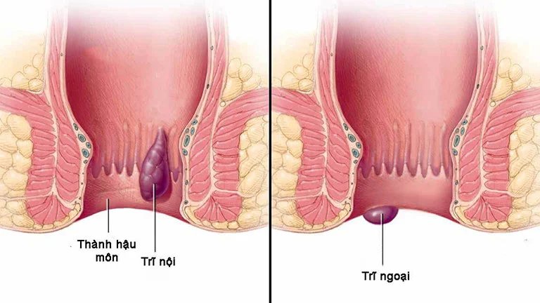 Tìm hiểu tổng quát bệnh trĩ