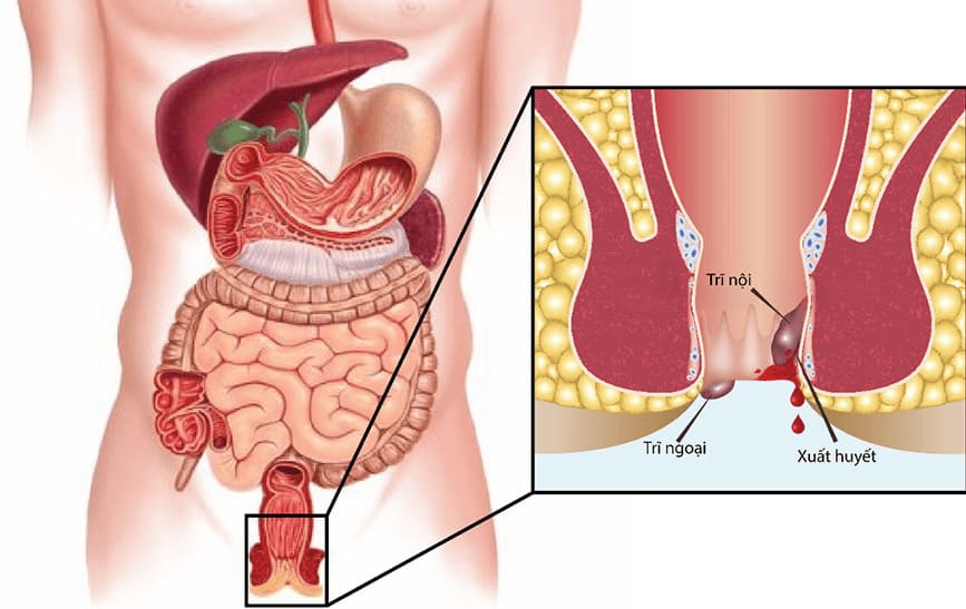 Nguy cơ bệnh trĩ khi không điều trị kịp thời